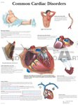 Common Cardiac Disorders - Anatomical Chart